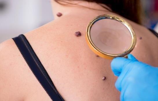 La incidencia de melanoma aumenta en 600 veces a nivel mundial en 20 años