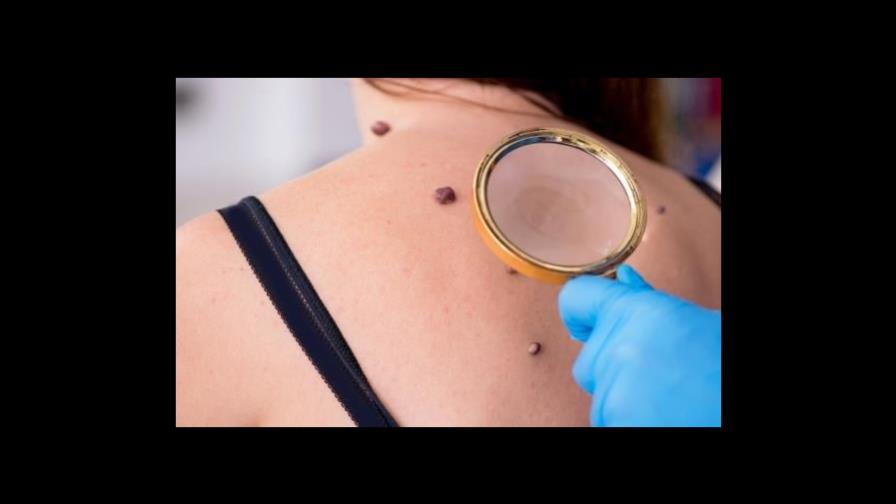 La incidencia de melanoma aumenta en 600 veces a nivel mundial en 20 años