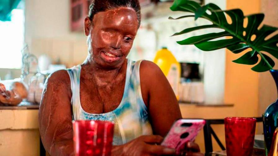 Casos con ácido del diablo se reducen pero la gravedad aumenta Casos con ácido del diablo se reducen pero la gravedad aumenta