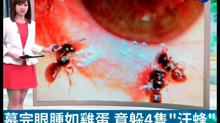Fue al hospital por infección y le encontraron cuatro abejas vivas en un ojo
