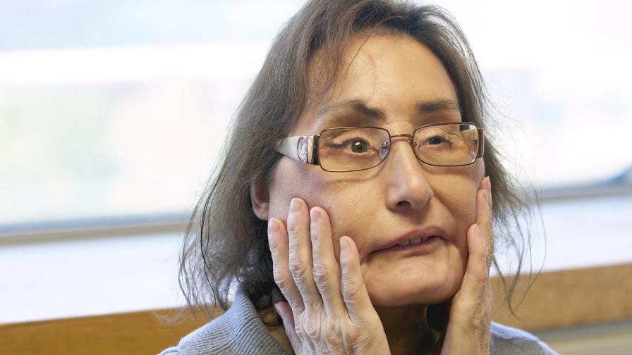 Fallece 1ra receptora de trasplante facial parcial en EEUU