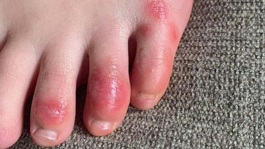 Dolencia dermatológica podría ser otro síntoma de COVID-19