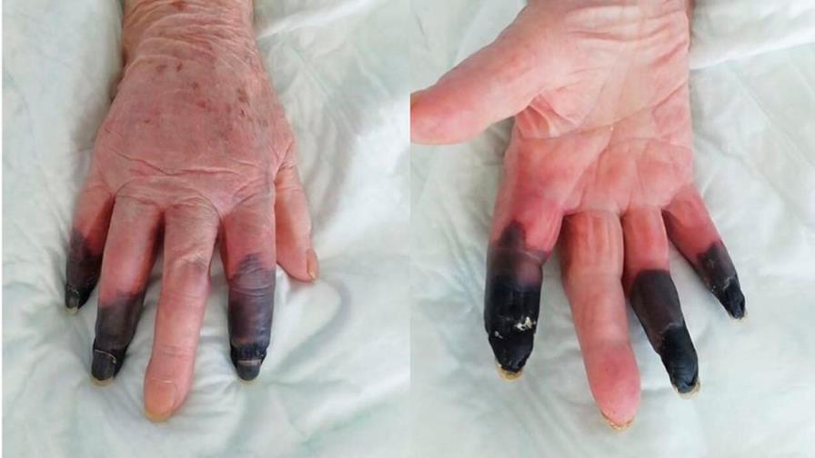 Amputan tres dedos a una mujer que desarrolló gangrena tras dar positivo al COVID-19 