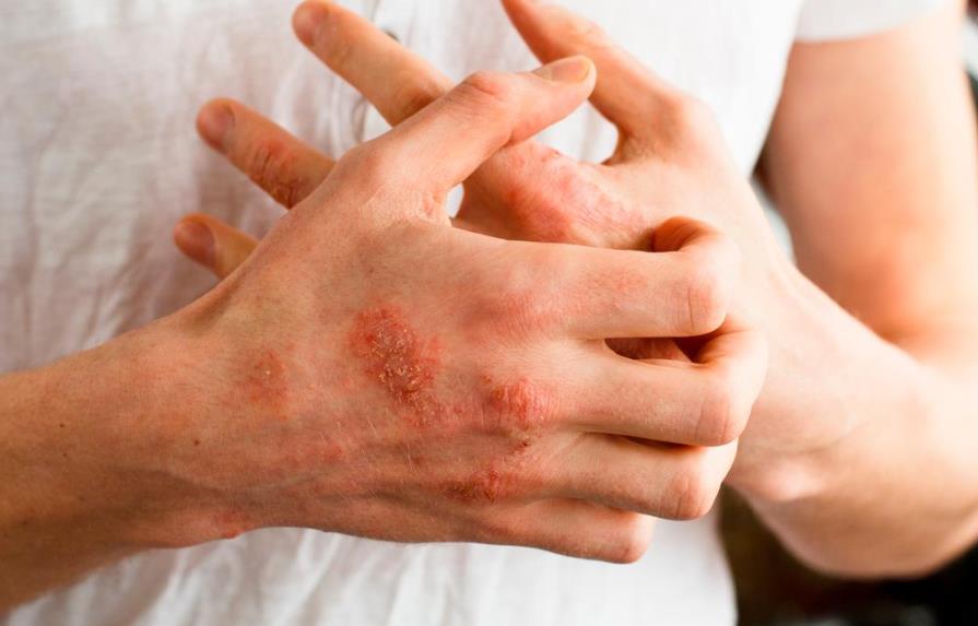 Dermatitis atópica se exacerba por medidas de higiene de COVID-19, según  expertos