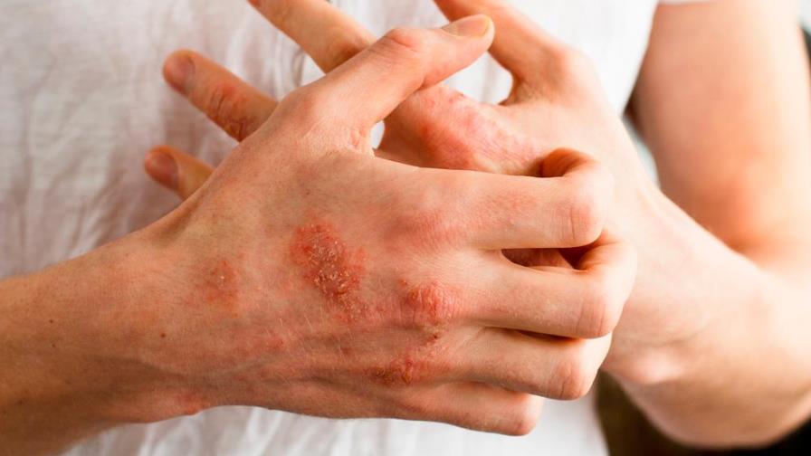 Dermatitis atópica se exacerba por medidas de higiene de COVID-19, según expertos Dermatitis atópica se exacerba por medidas de higiene de COVID-19, según expertos