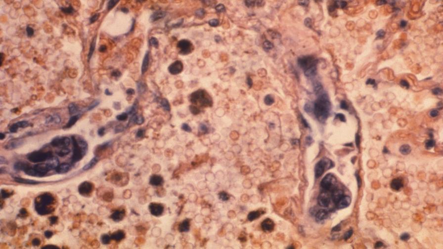 EEUU registra nueva caída récord en muertes por cáncer