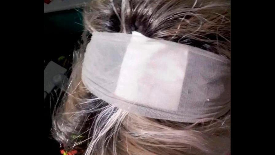 Mujer necesitó trasplante capilar luego de un tinte Mujer necesitó trasplante capilar luego de un tinte