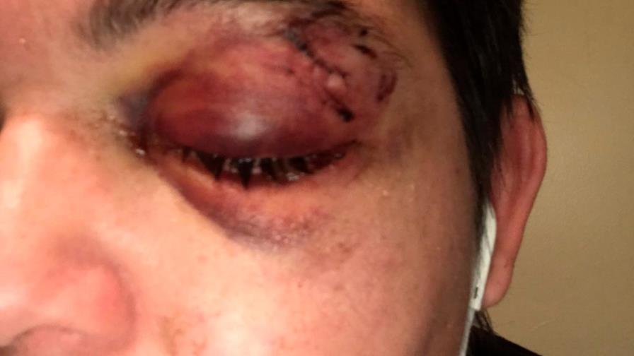 Fotógrafa que perdió un ojo en protestas: “Tienes que estar ciego para no ver el racismo”