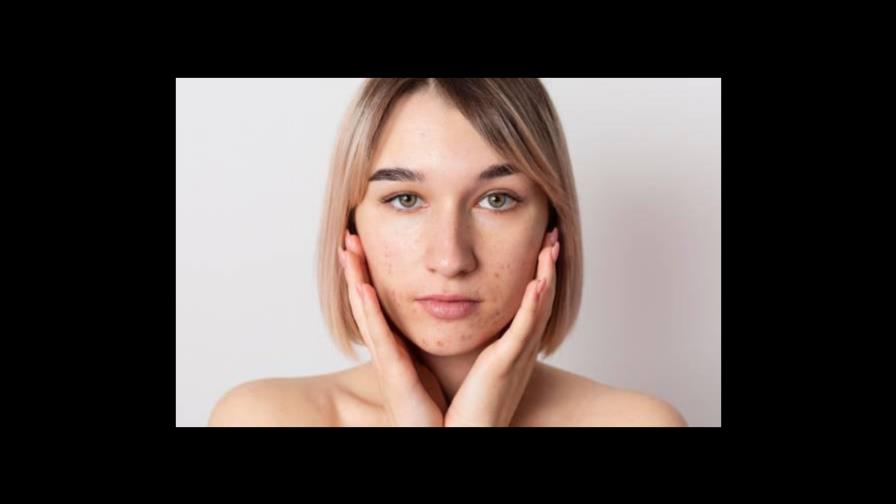 ¿Tienes acné? Así puedes evitar que te queden manchas