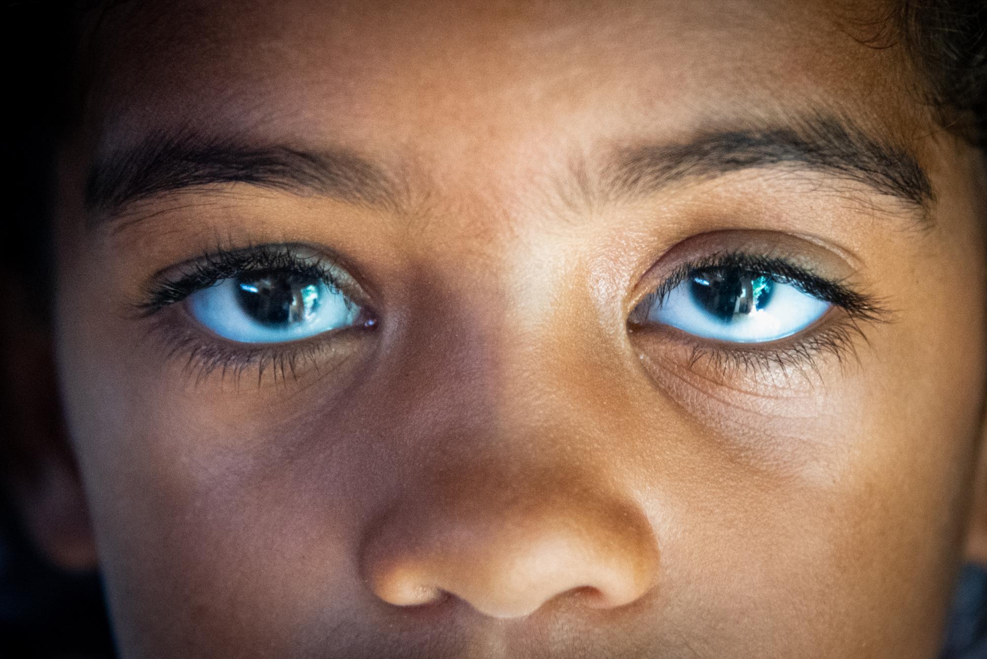 Con tan solo siete años de edad, el glaucoma afecta la visión de una niña que precisa una operación. (Juan Miguel Peña / Diario Libre)