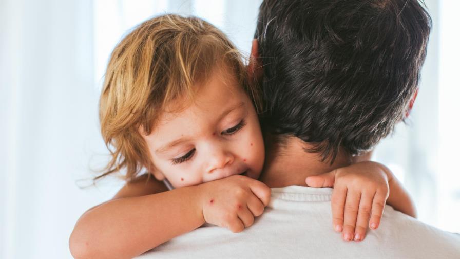 Reportan más de tres mil casos de varicela; uno de los brotes más altos en cinco años Reportan más de tres mil casos de varicela; uno de los brotes más altos en cinco años