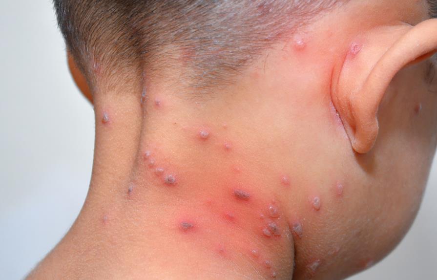 La varicela puede causar infecciones