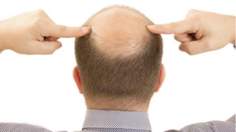 Desarrollan una nueva técnica regenerativa para combatir la calvicie 