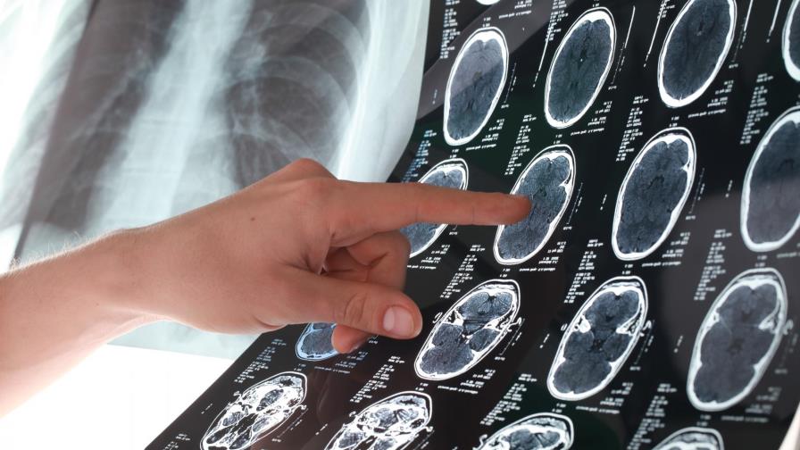 ¿Cómo puedo prevenir un accidente cerebrovascular? ¿Cómo puedo prevenir un accidente cerebrovascular?