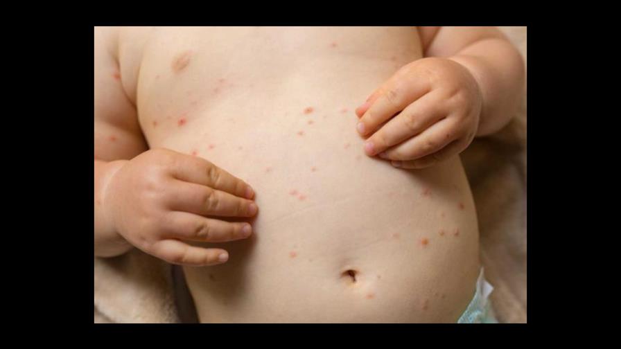 Aprueban en EEUU medicamento contra la viruela Aprueban en EEUU medicamento contra la viruela