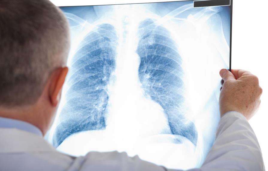Investigadores chinos descubren proteínas clave asociadas al cáncer de pulmón