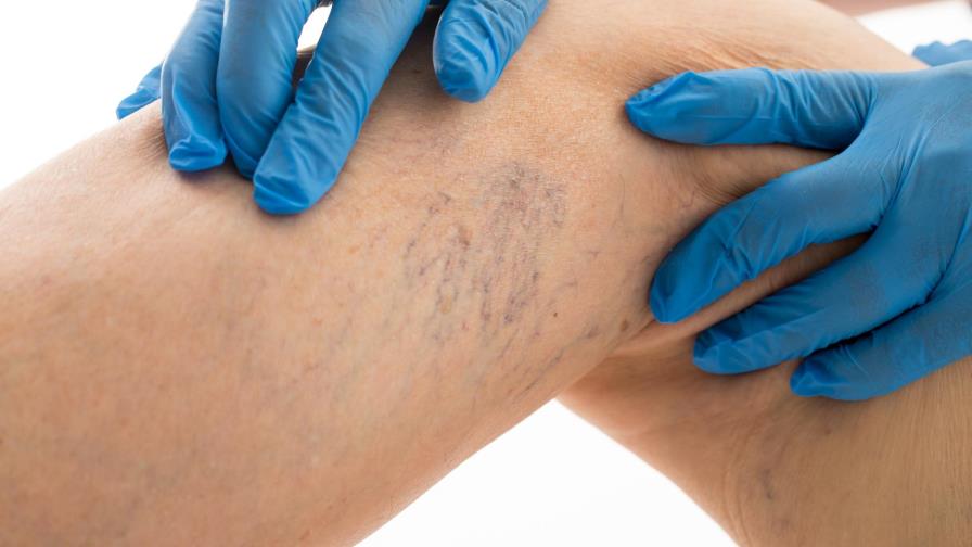 Varices pueden derivar en trombosis de no ser tratadas correctamente