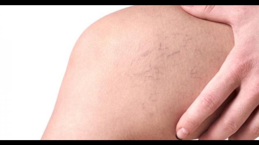 Obesidad, embarazo, sedentarismo y calor, factores para aparición de varices