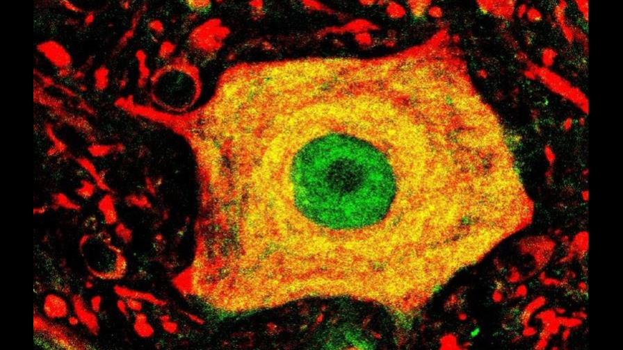 Científicos de 3 países avanzan en tratamiento de ELA