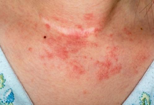 Nuevo fármaco disminuye la inflamación de la piel con dermatitis