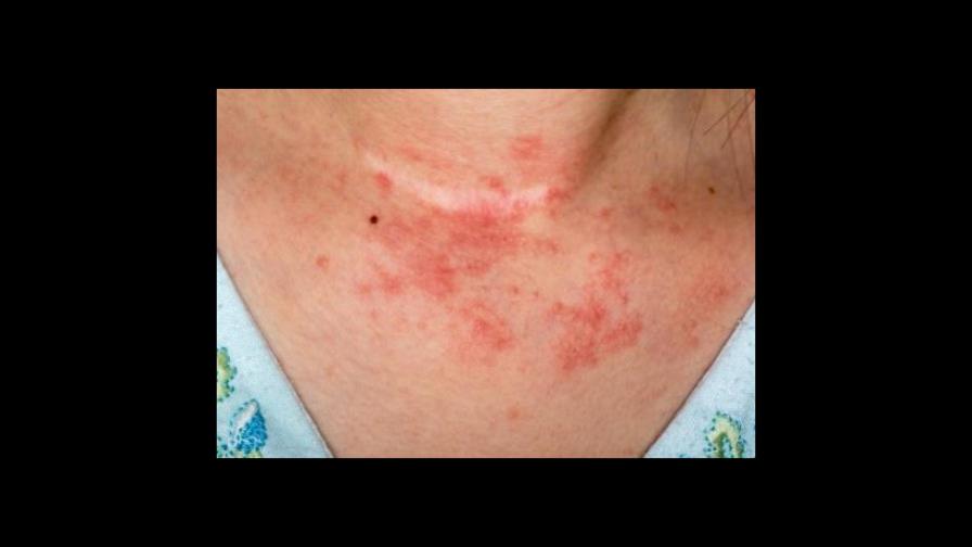 Nuevo fármaco disminuye la inflamación de la piel con dermatitis