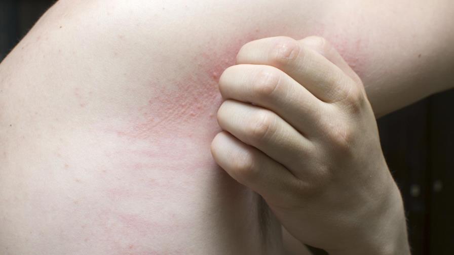 Día mundial de la Urticaria Crónica Día mundial de la Urticaria Crónica