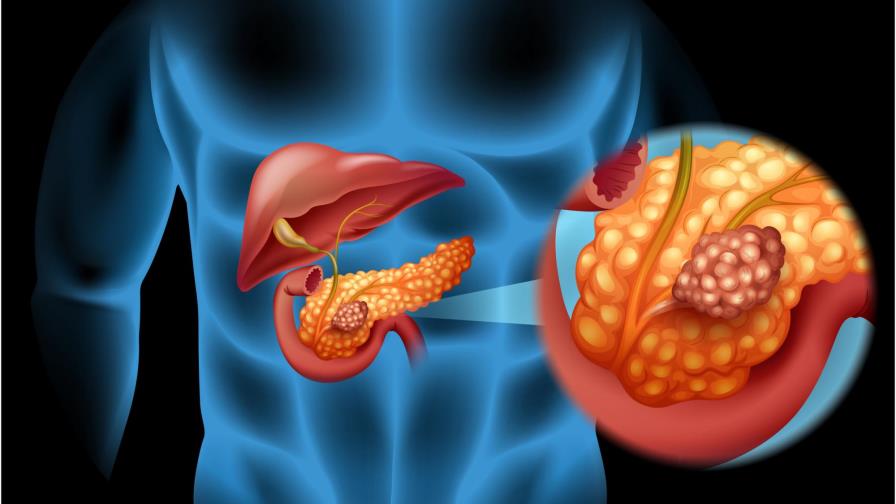 Presentan en México medicamento que ayuda en la lucha contra cáncer de páncreas 