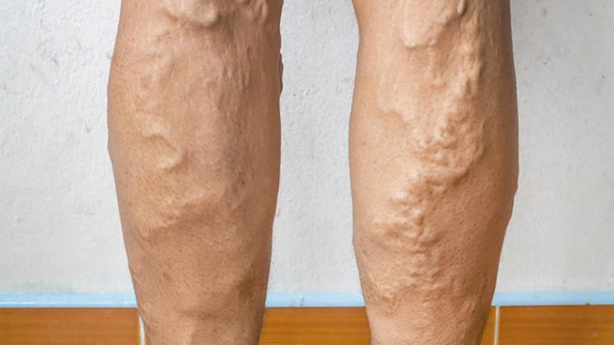 Inicia hoy congreso sobre trombosis
Comienza hoy Congreso Internacional sobre Hemostasia y Trombosis