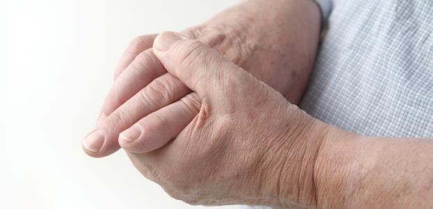 Advierten que la artritis reumatoide puede llevar a los pacientes a la invalidez 