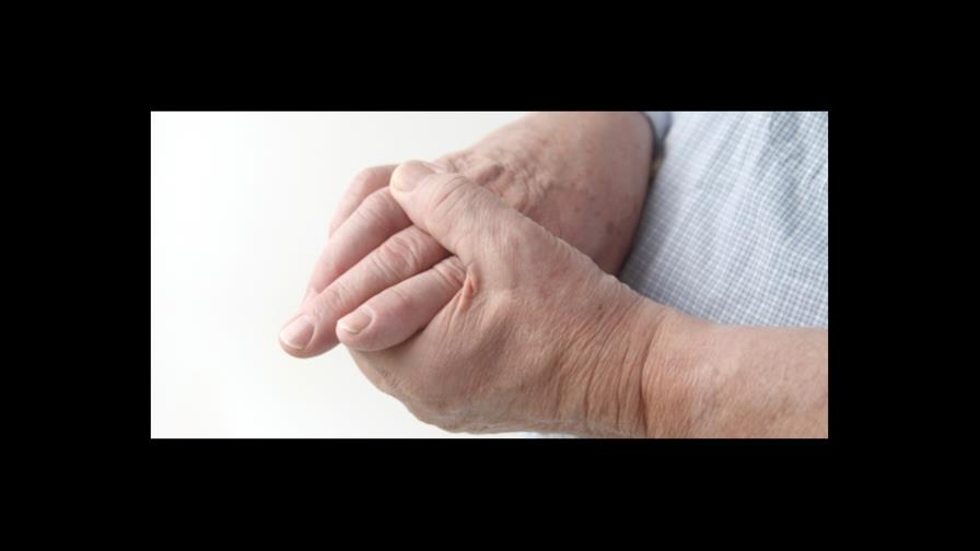 Advierten que la artritis reumatoide puede llevar a los pacientes a la invalidez 