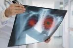 El 85 % de los casos de cáncer de pulmón se diagnostica tarde