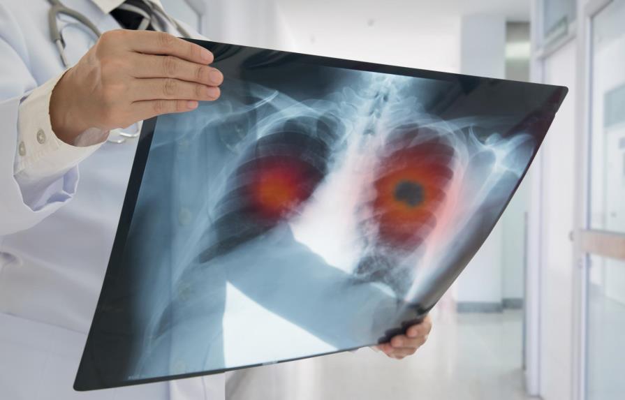 El 85 % de los casos de cáncer de pulmón se diagnostica tarde
