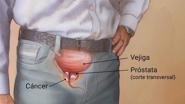 Cáncer de próstata: ¿Quién corre más riesgo?