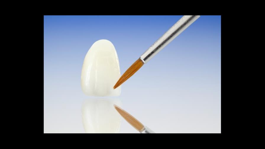 Carillas para sonrisas muy deslumbrantes