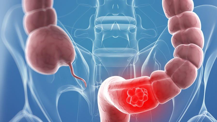 La microbiota juega un papel esencial en el crecimiento del cáncer de colon
