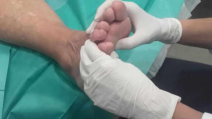 Crean medicamento
contra pie diabético