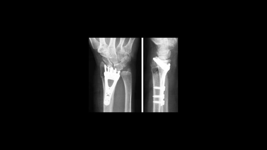 Descubren el proceso que activa la reparación de microfracturas en los huesos