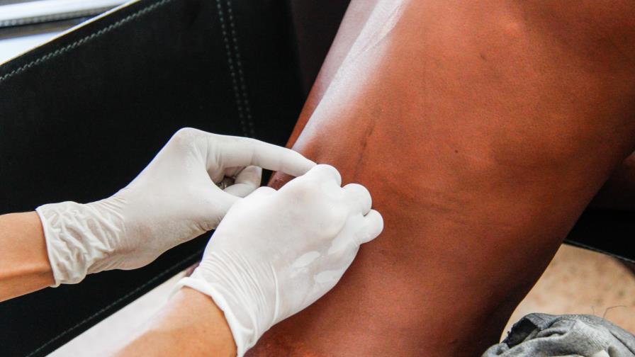 La lepra es motivo de mucha consulta dermatológica
La lepra no es epidémica