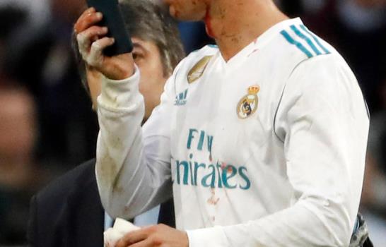 Cristiano Ronaldo herido cerca del ojo izquierdo; recibió puntos en su ceja izquierda 