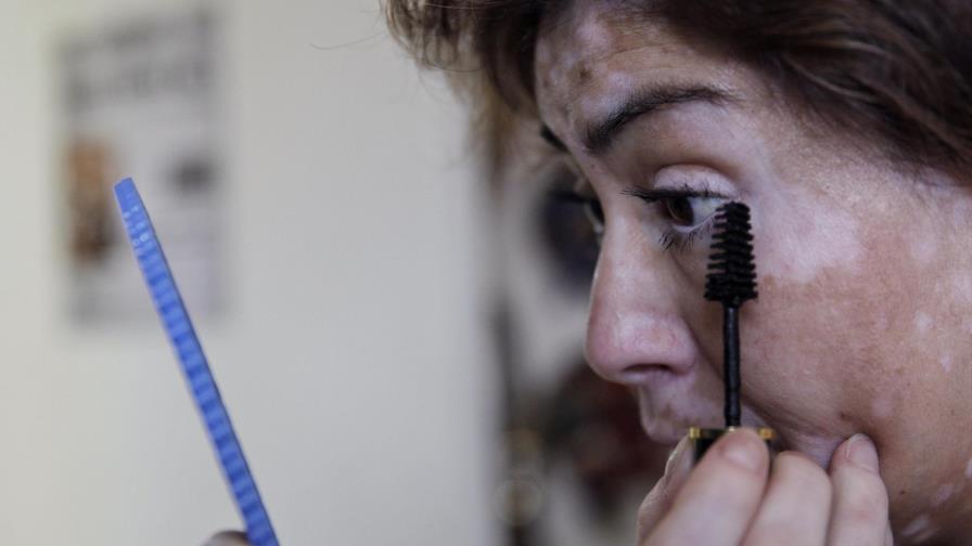 Vitiligo, una enfermedad multifactorial de lento tratamiento Vitiligo, una enfermedad multifactorial de lento tratamiento