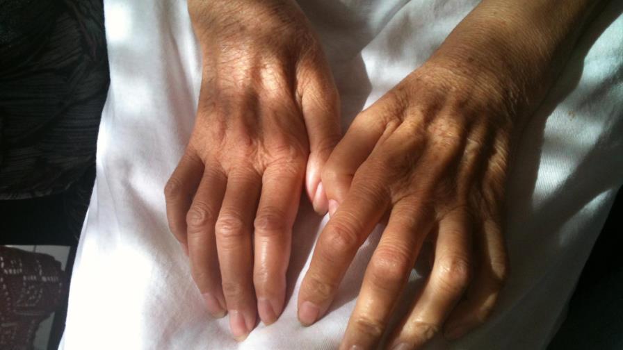 Imágenes 3D del interior de neuronas ayudan a avanzar en la enfermedad de ELA