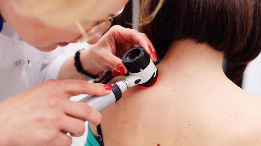 El melanoma que acecha a la población latinoamericana