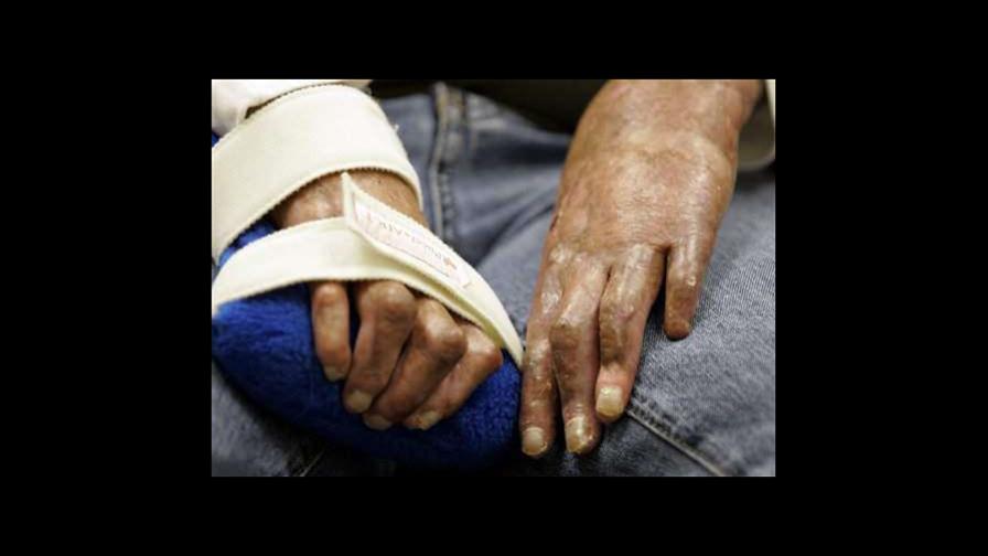 Aumentan las lesiones por quemaduras en hombres 