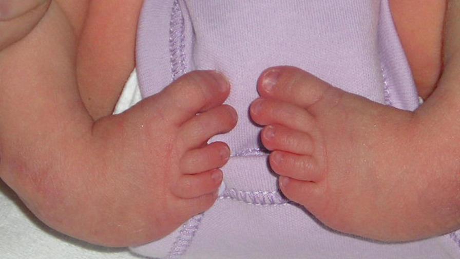 Identifican un gen que podría mejorar el tratamiento del pie equinovaro