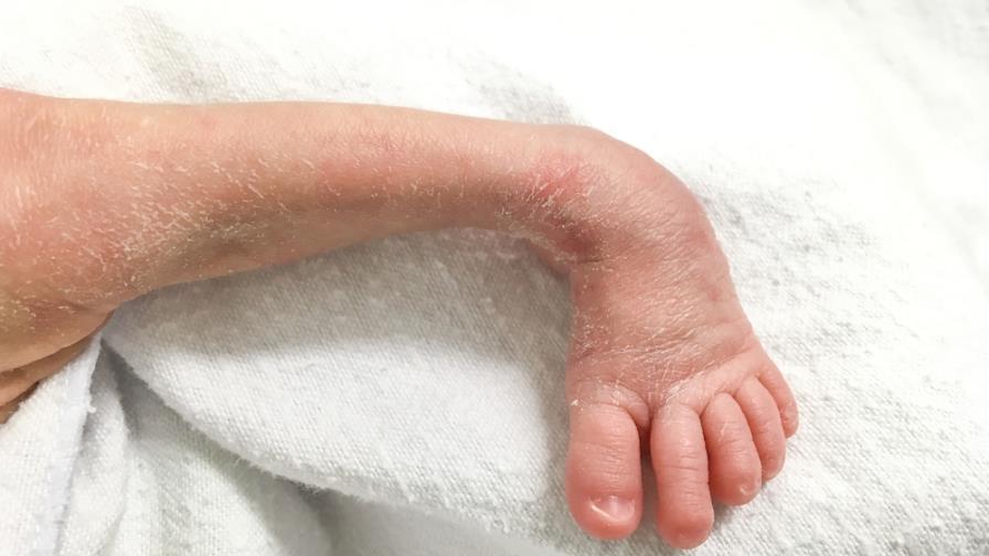 Fundación pide ayuda para identificar casos de pie equinovaro en el país