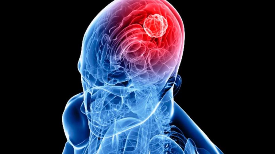 Una biopsia de líquido cefalorraquídeo permite diagnosticar tumor cerebral 