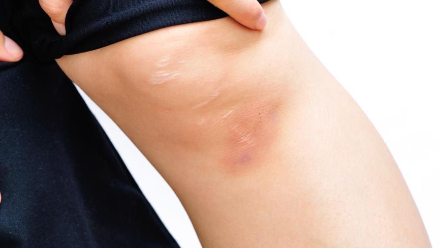 ¿Debo preocuparme por hinchazón en las piernas? ¿Debo preocuparme por hinchazón en las piernas?