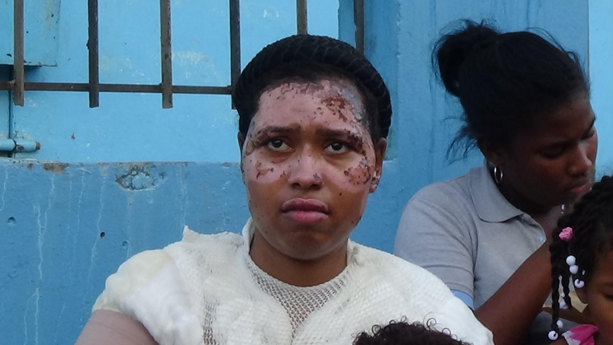 Viviani Veras Vicente, herida en incendio.