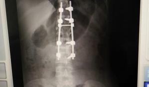 Cirujanos del Gautier realizan operación a joven que sufrió fractura columna