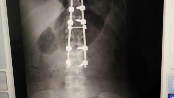 Cirujanos del Gautier realizan operación a joven que sufrió fractura columna
